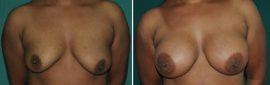 Result of silicone implant for breast in India